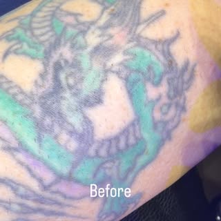 Electrolysis is 100% safe and effective for permanent hair removal in tattoos, regardless of hair co
