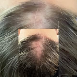 Are you or a loved one struggling with alopecia areata? Reach out today, we’d love to help. 🫶🏼 

☎