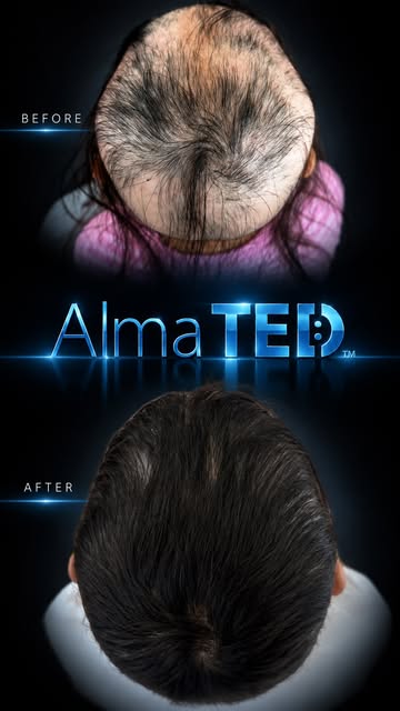 Alma TED Before / After:

This is why hair restoration can mean so much more than hair. ❤️

For an 1