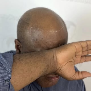 Nous avons créé une ligne frontal naturel et indétectable pour notre client ⚡️🔥 #microcapillaire 

