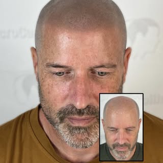 Transformation de Sylvain 🔥 ligne frontal doux et naturel. 

✅Consultation sans frais 
✅Résultats g
