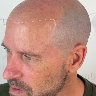 Bye bye la perte de cheveux 🔥 transformation de Sylvain. 

✅Consultation sans frais 
✅Résultats gar