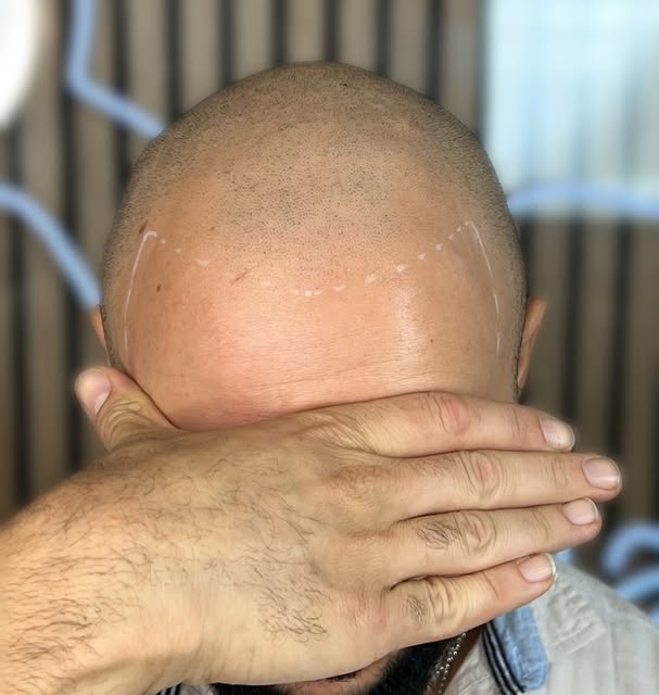 Creating natural hairlines that stay natural for life is what we do. @ace.microcapillaire #scalpmicr