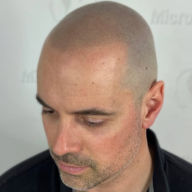 A natural hairline at its finest. 🔥
No one can believe he was bald before. This is what natural SMP