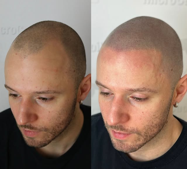 Bye bye la Calvitie🔥 #microcapillaire 

✅Consultation sans frais 
✅Résultats garantie 
☎️ 450 445 1