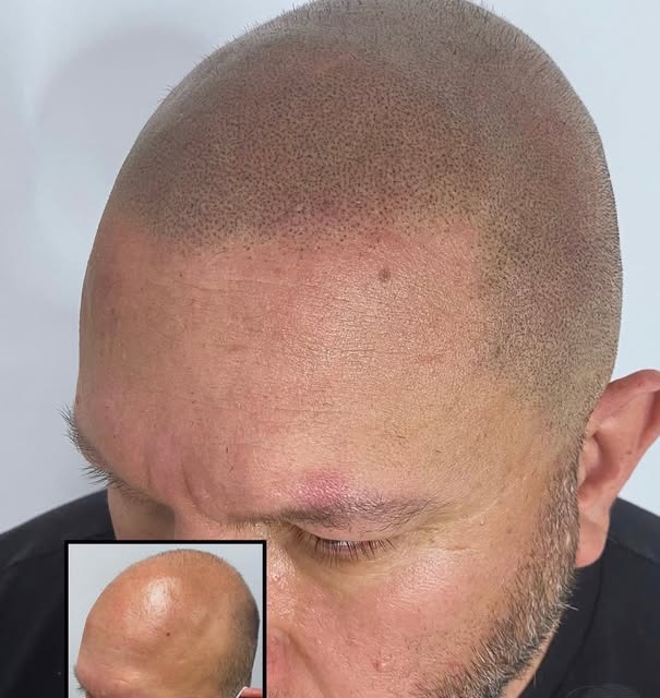 From bald to the look of a full head of hair no one can tell he’s had SMP with this naturally faded 