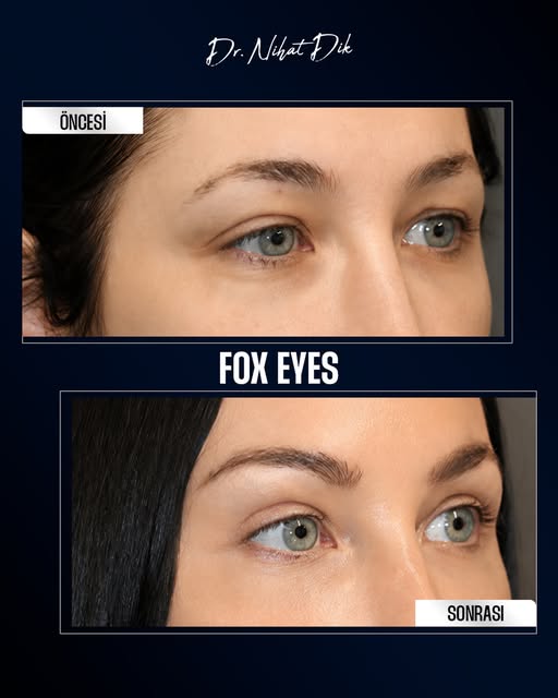 Göz çevresi ve kaş yapısındaki düşüklükler, kişiye yorgun bir ifade verebilir. Fox Eyes uygulaması, 