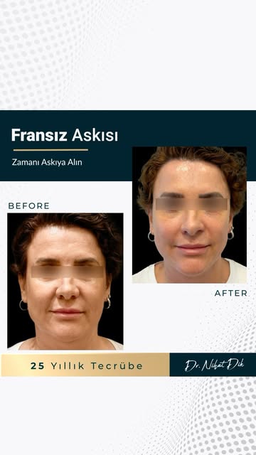Bu paylaşımda yer alan öncesi ve sonrası görseller, Fransız askısı uygulamasına ait olup bilgilendir