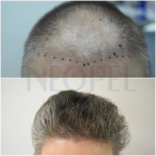 🔷Before/After #neopelhairclinic