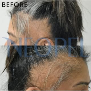 🔹Before/After #neopel