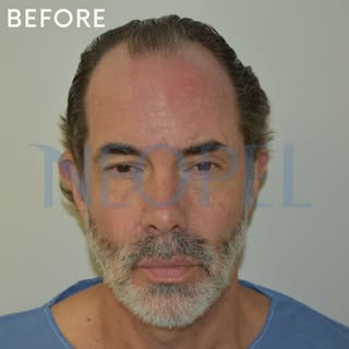 🔷BEFORE/AFTER 
swipe left for his incredible results 🤩