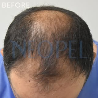 🔷Before / After 
Amazing results!!