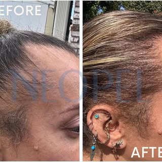🔷Before/after 
Traction alopecia in women
