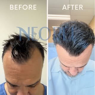 Before/After ⭐️ 

#neopelhairclinic #tijuana