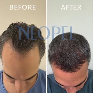 Before and After results🤩