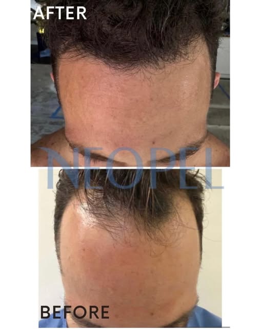 Before / after 🌟

✅ Restaura tus entradas con mas densidad y obtén un resultado natural 

✅ Restore
