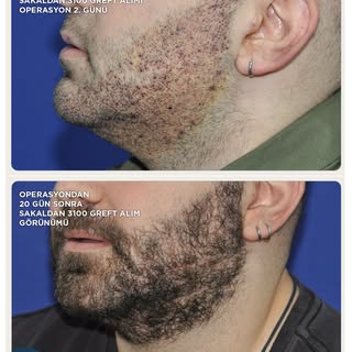 "When hair follicles are taken from the beard for body FUE hair transplantation, will there be any s