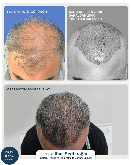 In cases of significant hair loss, particularly in Norwood grade 6 and 7 cases, hair follicles can b