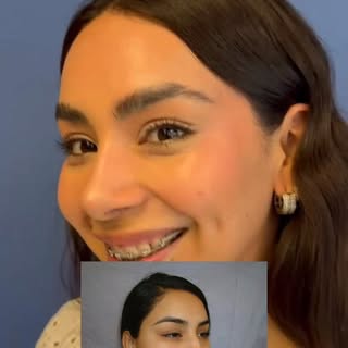 La clave de una buena rinoplastia es que se note el cambio, pero no la cirugía. Buscamos armonía fac