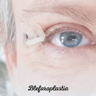 ✨ Rejuvenecer tu mirada es posible.

La blefaroplastia es un procedimiento quirúrgico diseñado para 