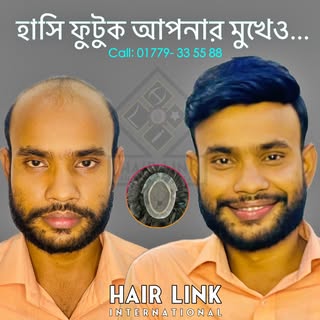 চুল না থাকা হতে পারে আপনার ডিপ্রেশন এর অন্যতম কারন ...
ইন শা আল্লাহ্‌ প্রযুক্তিগত সমাধান এখন আপনার হ