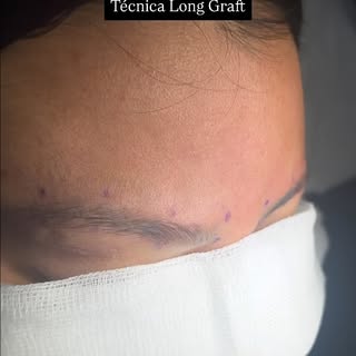 Trasplante Capilar en Cejas 🔝

Resultados permanentes, naturales y anatómicos al rostro de cada pac
