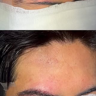 Las alopecias cicatrízales secundarias a traumas generan una pérdida completa de los folículos en la