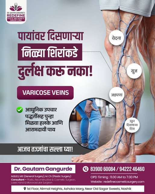 पायांवर दिसणाऱ्या निळ्या, फुगलेल्या शिरांकडे दुर्लक्ष करू नका!

Varicose Veins मुळे पायांमध्ये वेदना