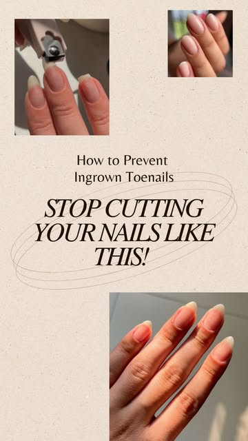 Ingrown toenail? Don’t try to “dig it out” yourself! ❌

Cutting the corners too deep or using sharp 