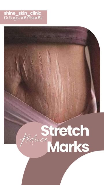 Stretch Marks: Can They Really Go Away? 🤔

Stretch marks are common and can appear due to rapid gro