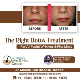 The right botox treatment for all facial wrinkles & fines lines
Dr. Mohan Skin Disease Hospital
Webs