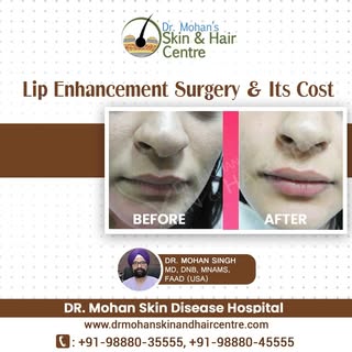 Lip enhancement surgery & its cost
Dr. Mohan Skin Disease Hospital
Website: https://drmohanskinandha