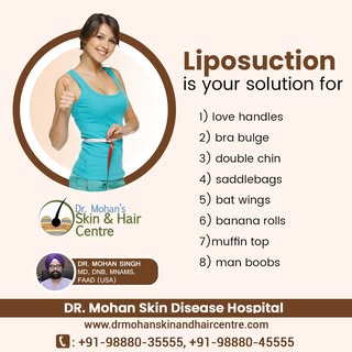 Liposuction is your solution for 
Love Handles
Bra Bulge
Double Chin
Saddlebags
Bat Wings
Dr. Mohan 