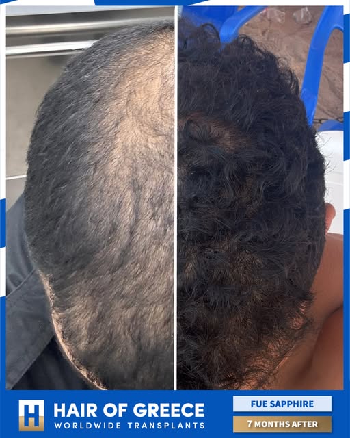 7 חודשים בלבד אחרי השתלת שיער בשיטת FUE SAPPHIRE במרפאת HAIR OF GREECE באתונה 🇬🇷 💙 🇮🇱 לכל הפרטי