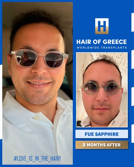 8 חודשים בלבד לאחר ההשתלה!
מרפאת HAIR OF GREECE באתונה - השתלות השיער הטובות בעולם.
לפרטים דברו איתנ