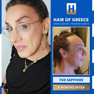 ⁨	6 חודשים בלבד אחרי השתלת שיער בשיטת FUE SAPPHIRE במרפאת HAIR OF GREECE באתונה 🇬🇷 💙 🇮🇱 לכל הפר