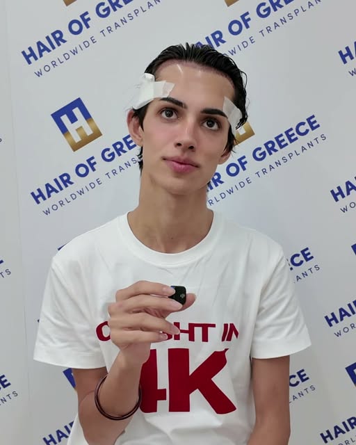 ⁨	רק עברתי השתלה ואני נראה מדהים :)
מרפאת HAIR OF GREECE באתונה, השתלות השיער הטובות בעולם!

#השתלתש