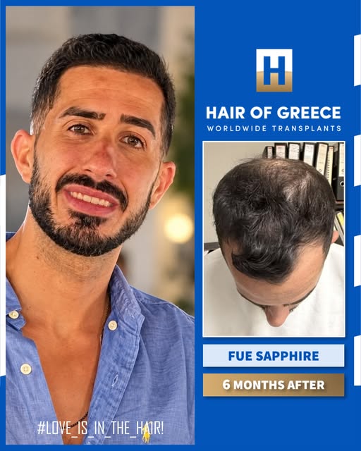 ⁨	6 חודשים בלבד לאחר ההשתלה!
מרפאת HAIR OF GREECE באתונה - השתלות השיער הטובות בעולם.
לפרטים דברו אי