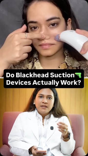 Can that viral blackhead vacuum actually help your skin? 👀

• Blackhead removal is not the same as 