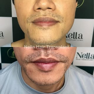 💥Results after 9 months of Micro FUE beard transplant, performed by Dr. Hien.

Not satisfied with t
