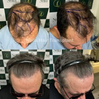 🍀 BEFORE - AFTER 06 MONTHS OF HAIR TRANSPLANT

Our customer from England got 4,000 grafts transplan