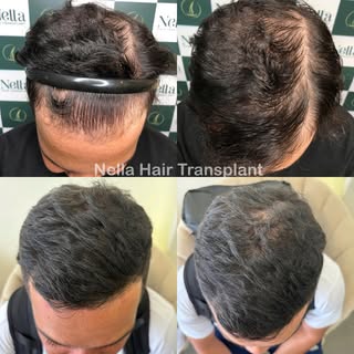 RESULTS AFTER 6 MONTHS OF HAIR LOSSS TREATMENT WITH DR. HIEN

Our client first came to Nella with a 