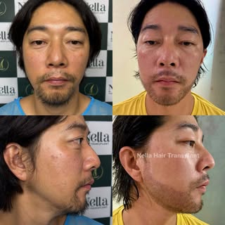 💥 Stunning Result: Micro FUE Beard Transplant by Dr. Hien

Our Korean patient dreamed of a fuller, 