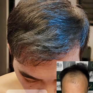 🍀 9 Months After Hair Transplant in Vietnam!

Our amazing client from Singapore had 5,200 grafts do