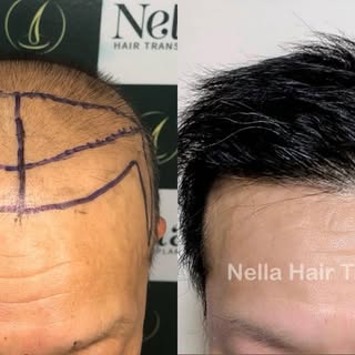 7-Month Result – Micro FUE | Performed by Dr. Hien

From a receding hairline that affected confidenc