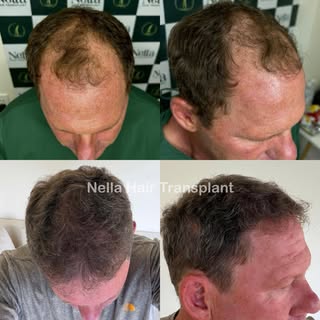 ✨ Hair Transplant Transformation – 9-Month Result ✨

A remarkable turnaround for this patient follow