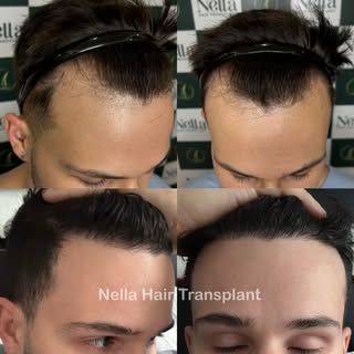 ✨ 2300 Grafts | 9 Months Result 
Micro FUE Technique – Performed by Dr. Hien

Frontal hairline reces