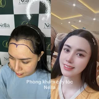 ✨ 1-Year Transformation | Lower Hairline for Female with Micro FUE ✨ 

Meet our beautiful patient, M