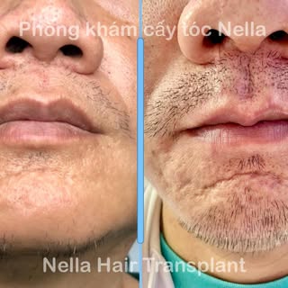A natural beard starts with the right technique.

1-year beard transplant result by Dr. Hien ✨

This