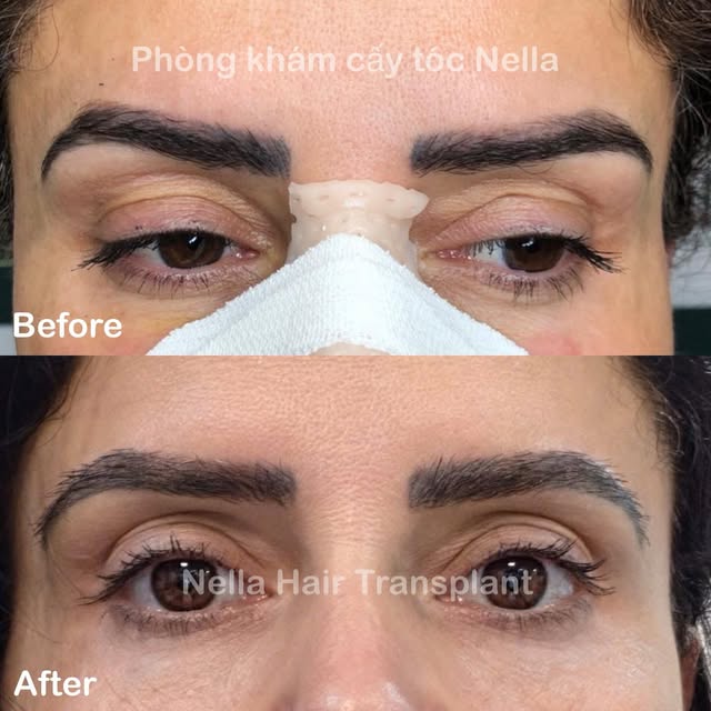 Natural Eyebrow Transplant in Vietnam: Overcoming Faded Microblading ✨

Tired of drawing, filling, o